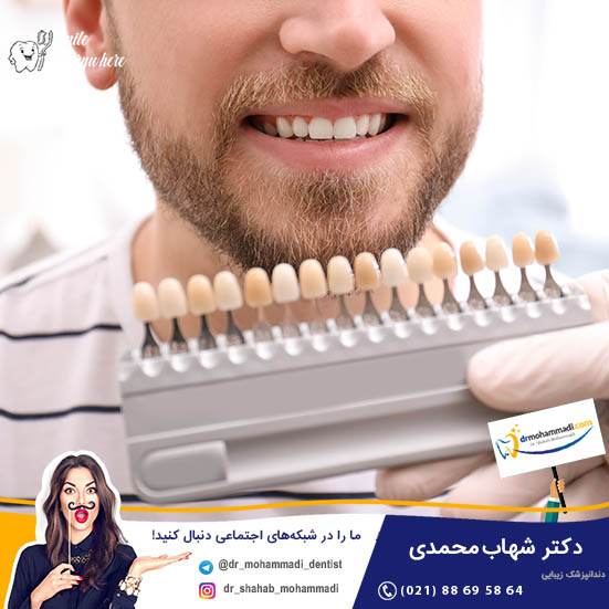کاندید مناسب برای کامپوزیت ونیر چه کسی است؟ - کلینیک دندانپزشکی دکتر شهاب محمدی